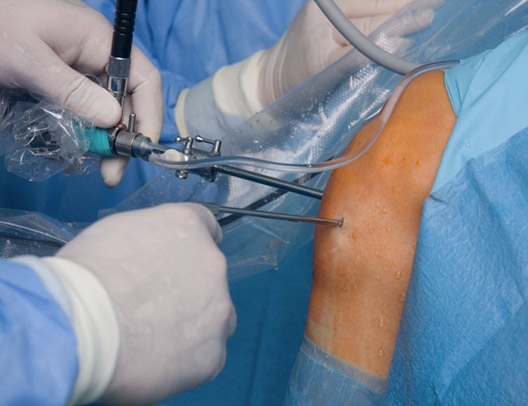 Investigación anestesia general vs regional para cirugía artroscópica ambulatoria de rodilla